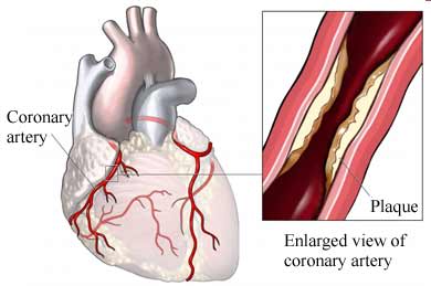 Coronary Artery plaque