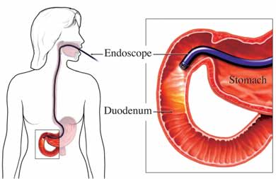 Endoscope in stomach