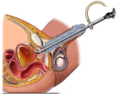 Transurethral Resection of the Prostate (TURP)