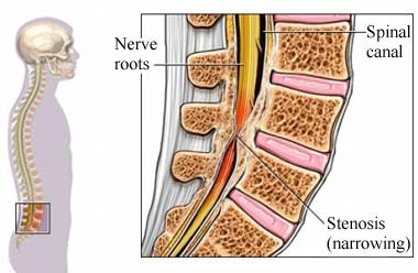 Stenosis of spine with punched nerve