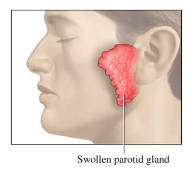 Swollen Parotid Gland