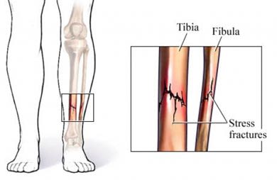Tib / Fib fracture