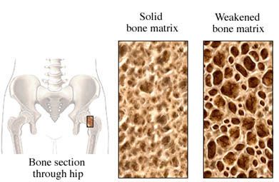 Weakened bone at hip