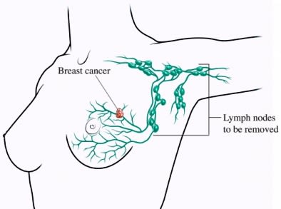 lymph nodes to be removed