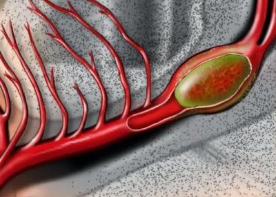 GN00002_brain aneurysm.jpg