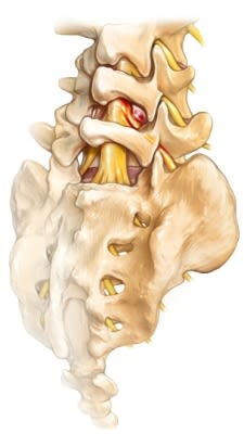 lumbar disc herniation back