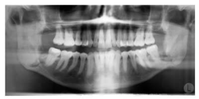 Jaw x-ray teeth