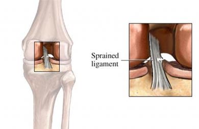 Sprained ligament knee