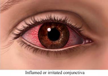 Inflamed conjunctiva
