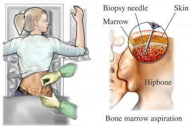 Bone biopsy