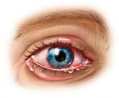 Eye Inflammation