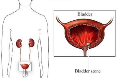 si1713_bladder stone