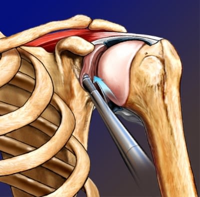 Shoulder joint repair
