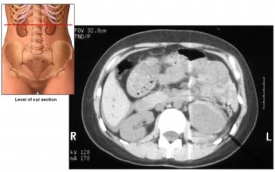 kidney CT scan