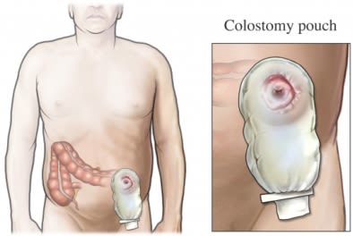 colostomy pouch