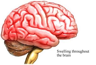 Swollen brain