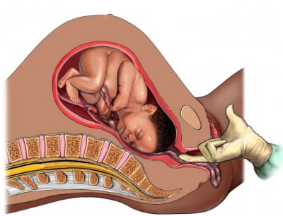 Prolapsed Umbilical cord
