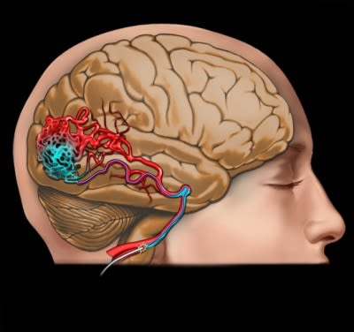 AVM brain blood vessels