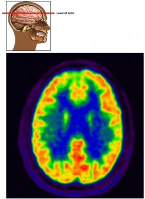PET scan head brain