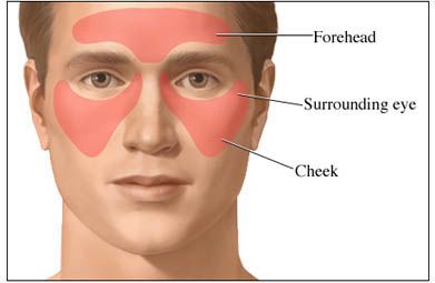 Sinus Headache: Areas of Pain