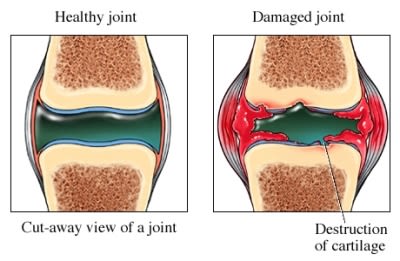 Damaged Joint