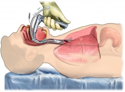 Intubation for respiration