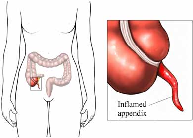 Inflammed appendix