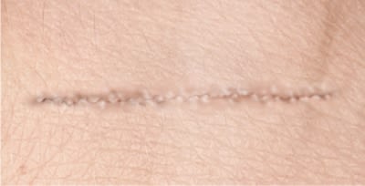 Post-operative scar