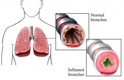 Inflammed Lung and asthma