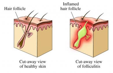 Inflammed hair follicle