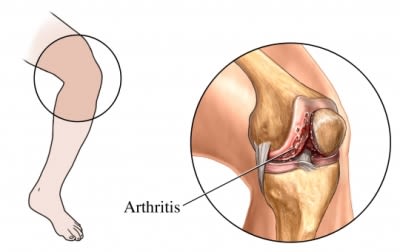 Knee arthitis