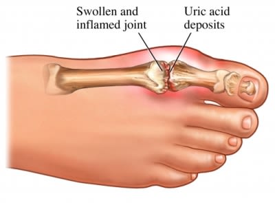 uric acid toe