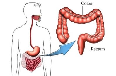 colectomy colon