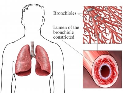 Asthma lung