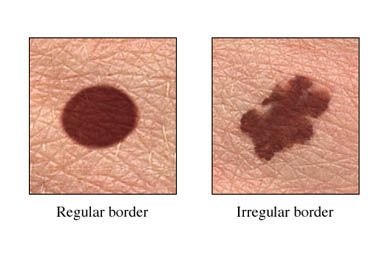 Skin Cancer Sign: Irregular Border on Mole