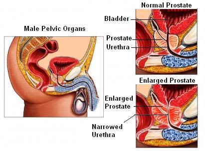 BPH prostate