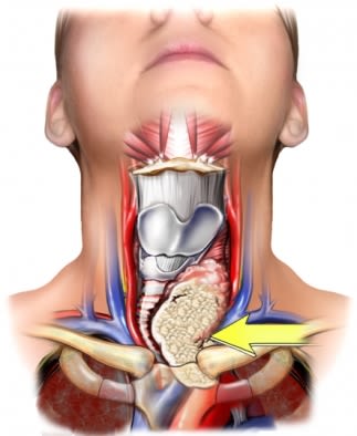 Thyroid tumor