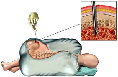 Bone Biopsy pelvis