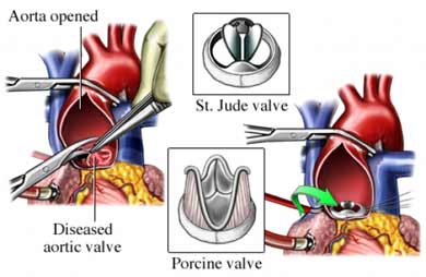 heart valve replacement