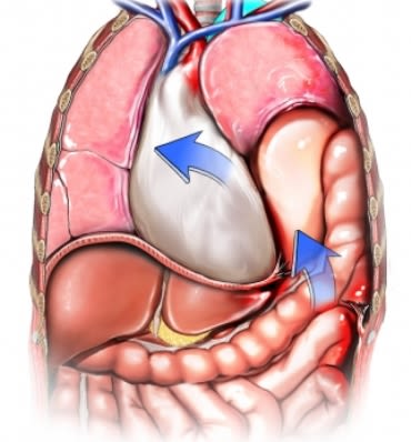 Herniated Diaphragm