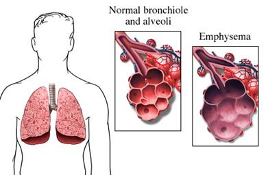 Normal Lung and Emphysemic Lung