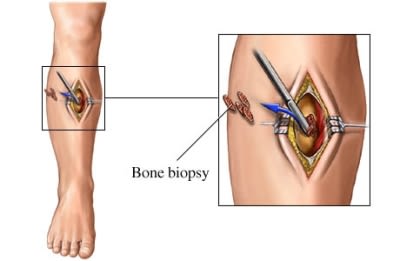 Bone biopsy