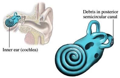 Inner ear deposits