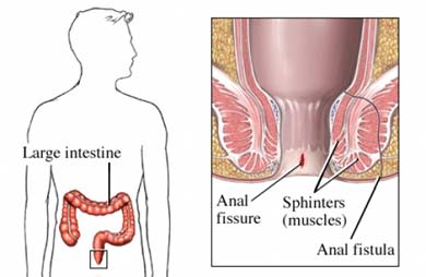 Anal fissure and fistula