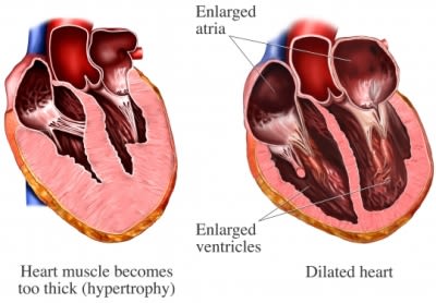 Heart wall disease
