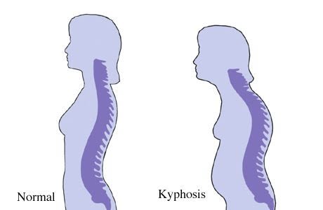 kyphosis Spine